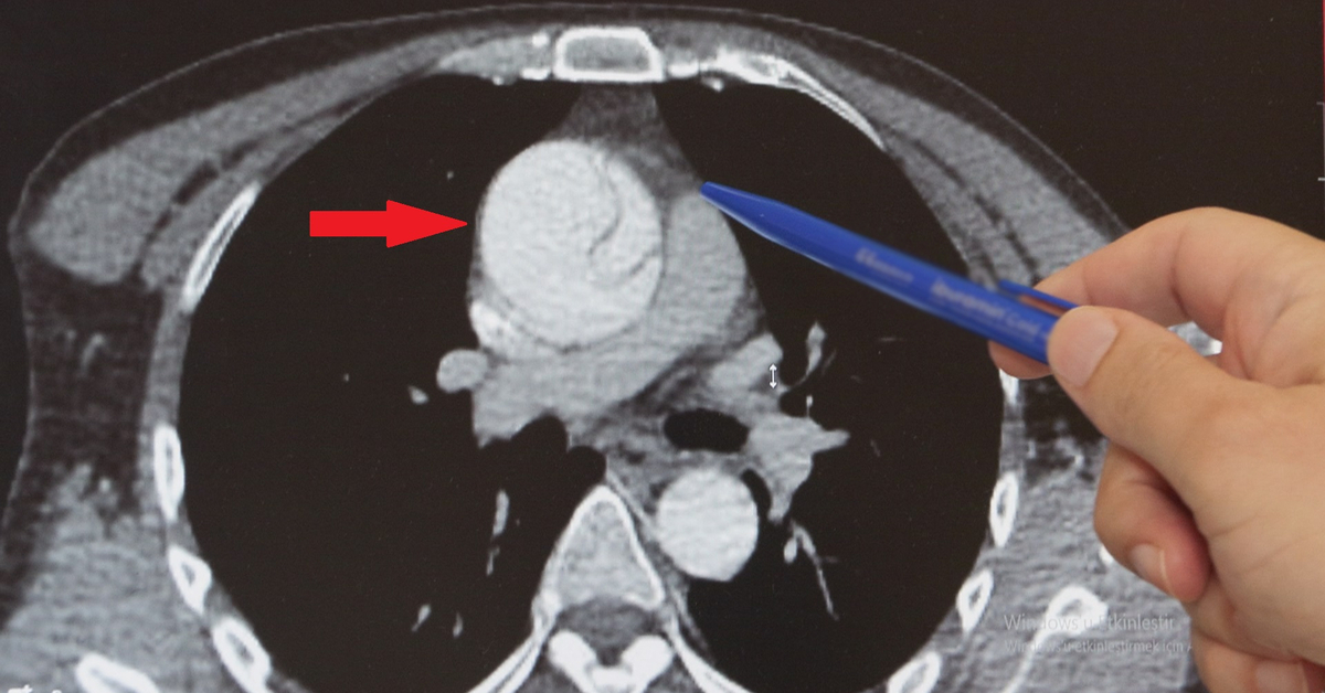 Mide ağrısı sandı, aortunda yırtık çıktı