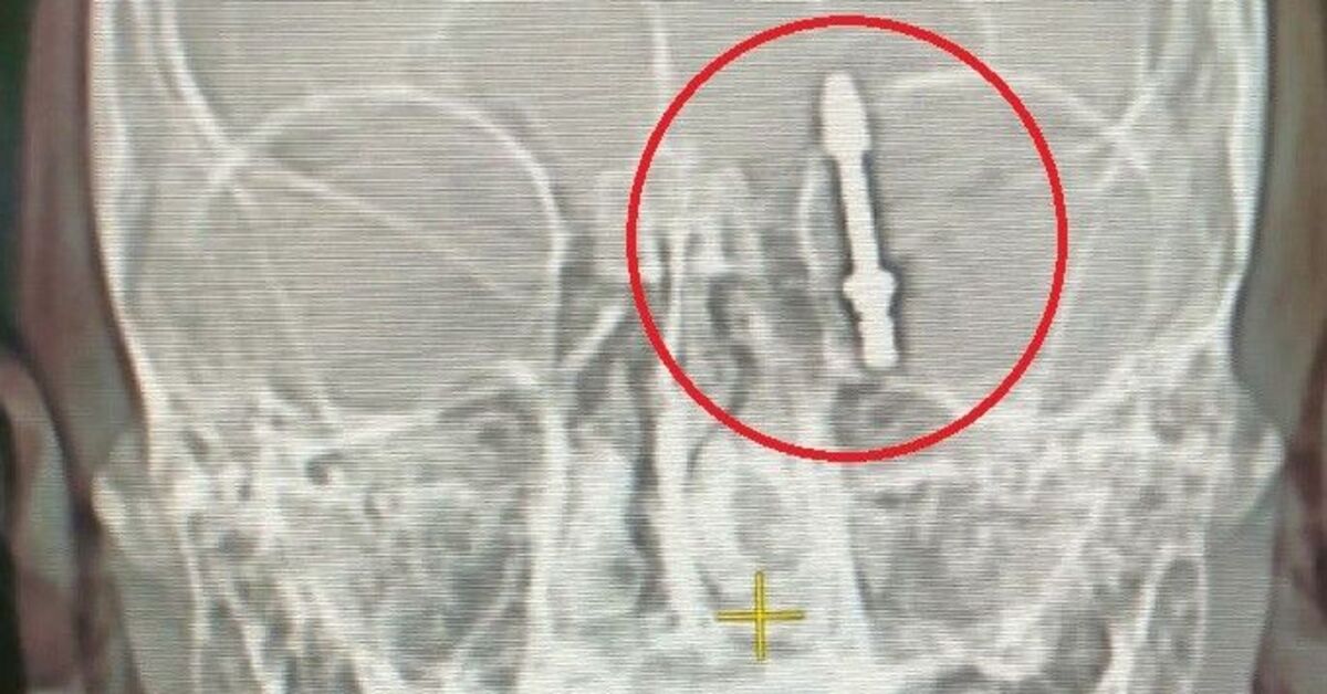 Diş implantı omurilik sıvısına giren ve ameliyatla iyileşen kişi hukuk mücadelesi veriyor! - Haberler