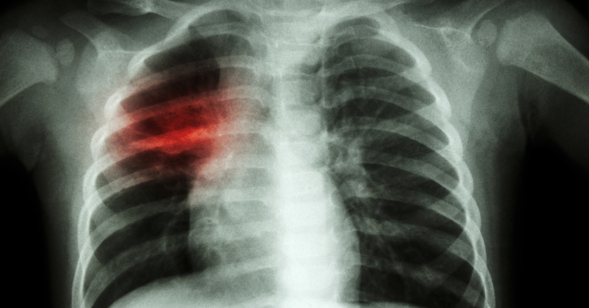 İnfluenza B akciğer enfeksiyonuna yol açıyor - Haberler
